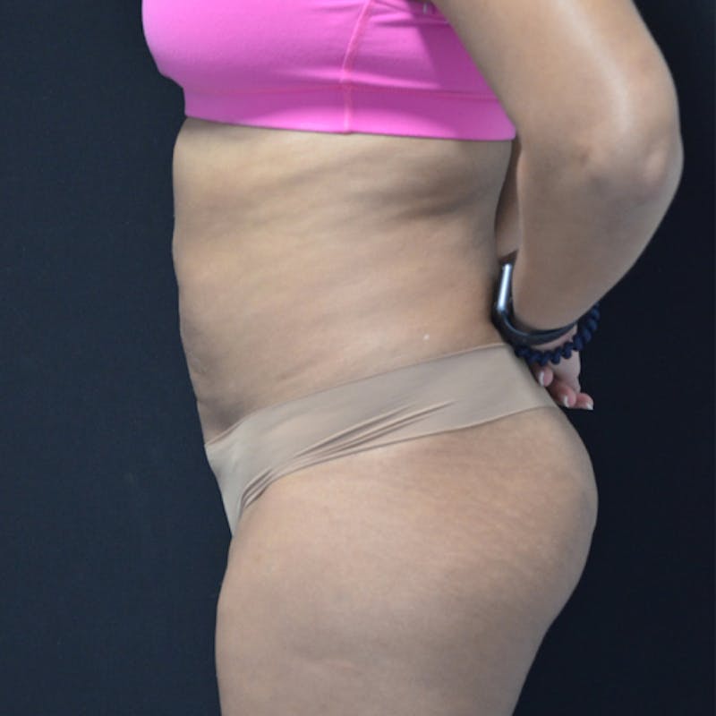 Liposuction Before & After Gallery - Patient 114721135 - Image 9