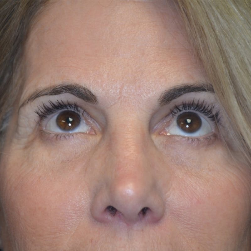 Lower Eyelid Surgery Before & After Gallery - Patient 118186860 - Image 2
