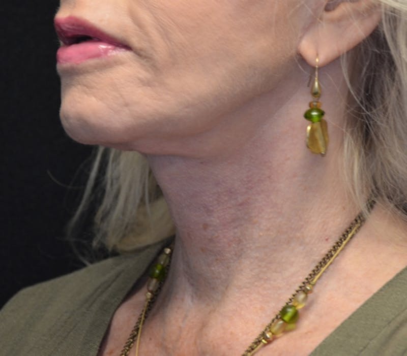Neck Lift Before & After Gallery - Patient 114721133 - Image 4