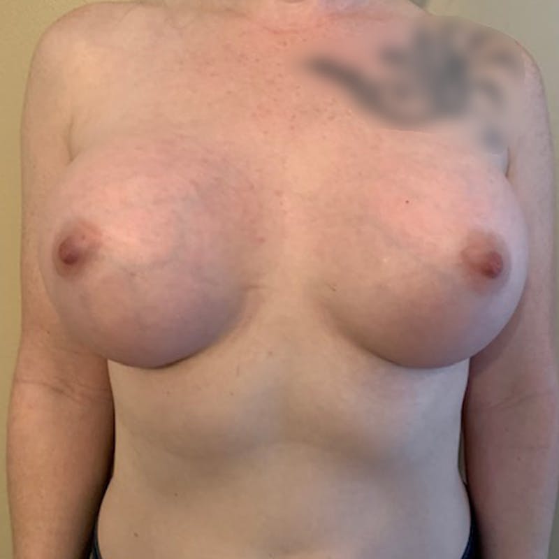 Breast Augmentation Before & After Gallery - Patient 114721134 - Image 2
