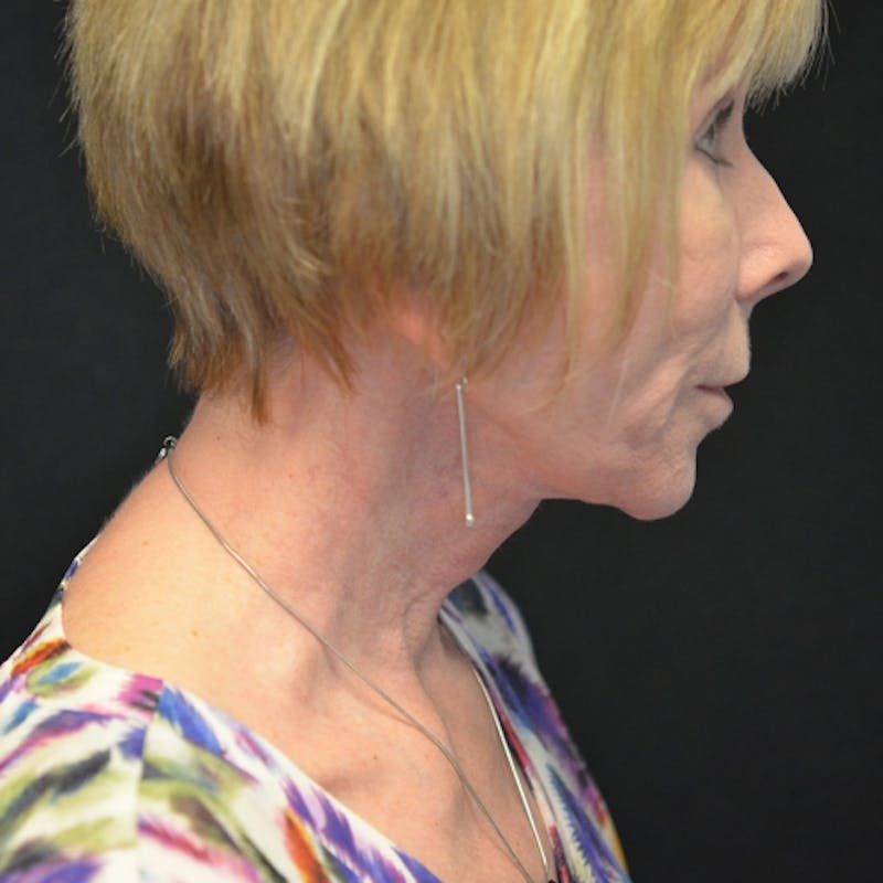 Facelift Before & After Gallery - Patient 114721137 - Image 6