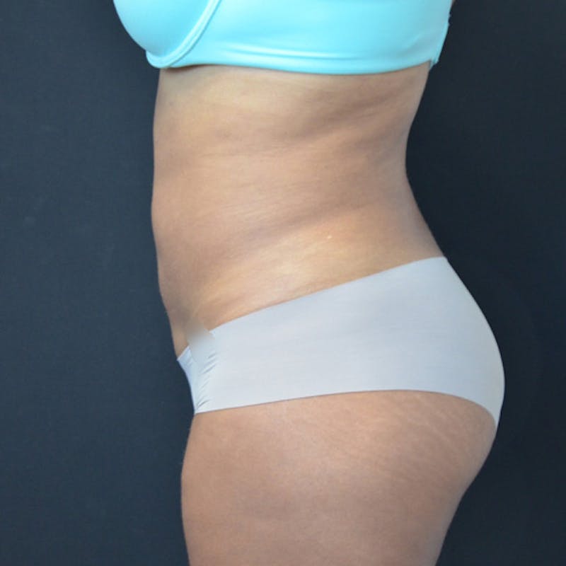 Liposuction Before & After Gallery - Patient 114721135 - Image 10