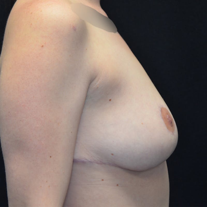 Breast Reduction Before & After Gallery - Patient 114721139 - Image 6