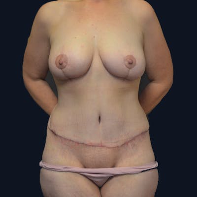 Mommy Makeover Before & After Gallery - Patient 114721147 - Image 2