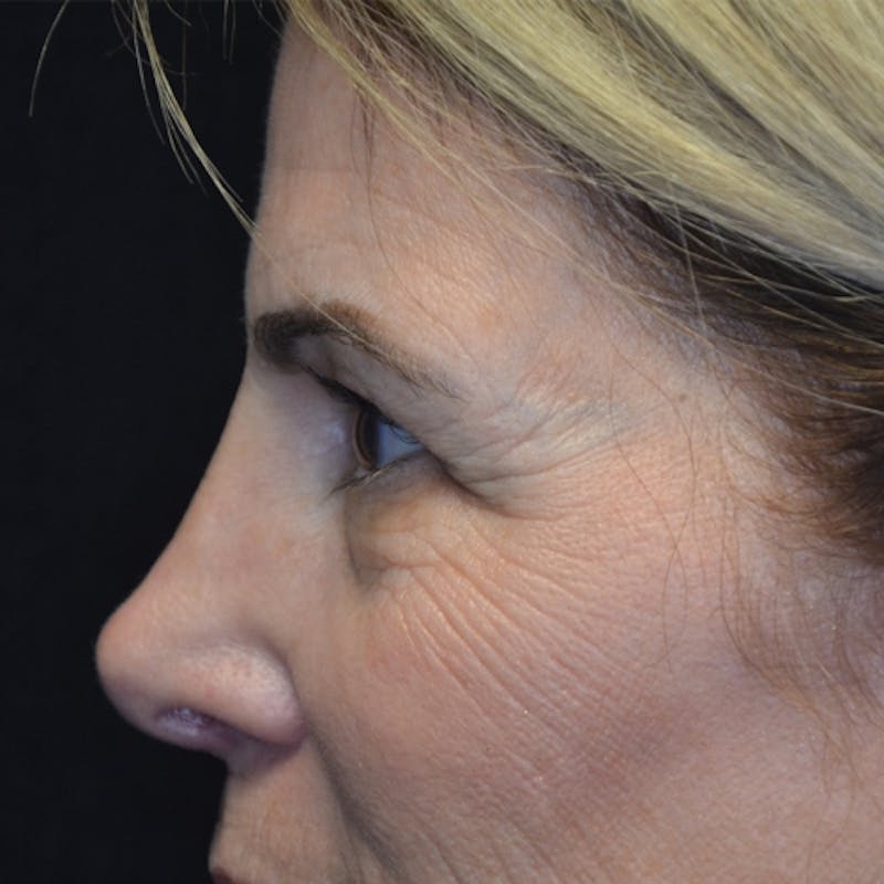 Lower Eyelid Surgery Before & After Gallery - Patient 118186860 - Image 5