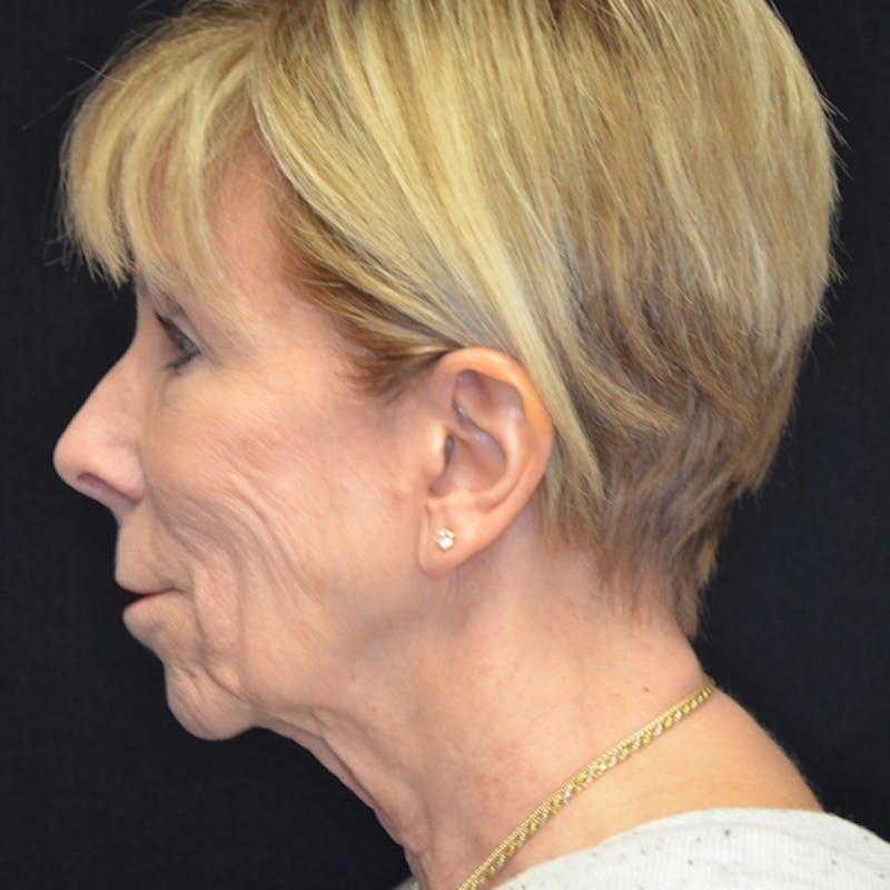 Facelift Before & After Gallery - Patient 114721137 - Image 9