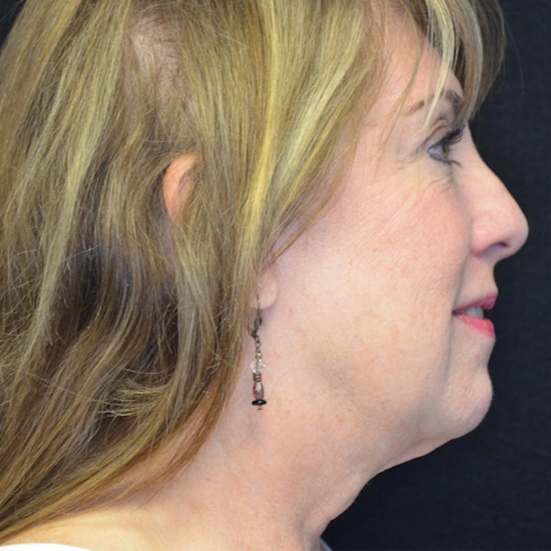Neck Lift Before & After Gallery - Patient 114721145 - Image 9