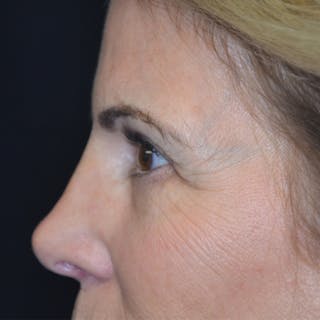 Lower Eyelid Surgery Before & After Gallery - Patient 118186860 - Image 6
