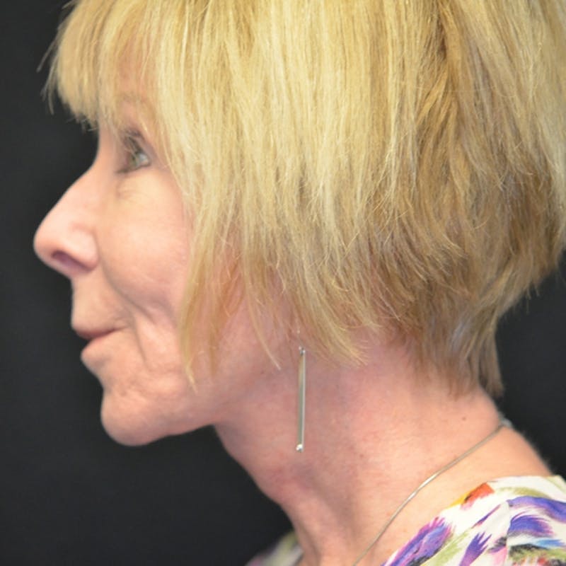 Facelift Before & After Gallery - Patient 114721137 - Image 10