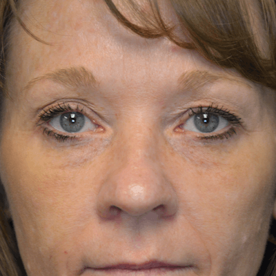 Upper Eyelid Surgery Before & After Gallery - Patient 114721140 - Image 1