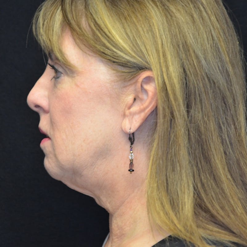 Neck Lift Before & After Gallery - Patient 114721145 - Image 1