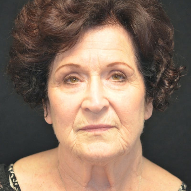 Facelift Before & After Gallery - Patient 114721148 - Image 1