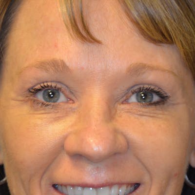 Upper Eyelid Surgery Before & After Gallery - Patient 114721140 - Image 2