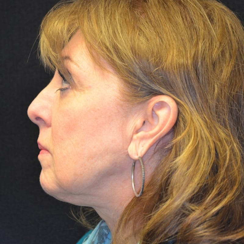 Neck Lift Before & After Gallery - Patient 114721145 - Image 2