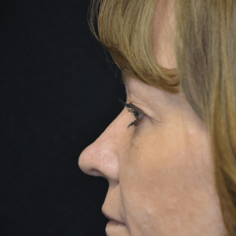Upper Eyelid Surgery Before & After Gallery - Patient 114721140 - Image 3
