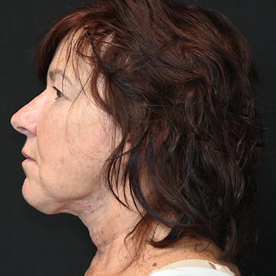 FaceTite by InMode Before & After Gallery - Patient 114721146 - Image 1