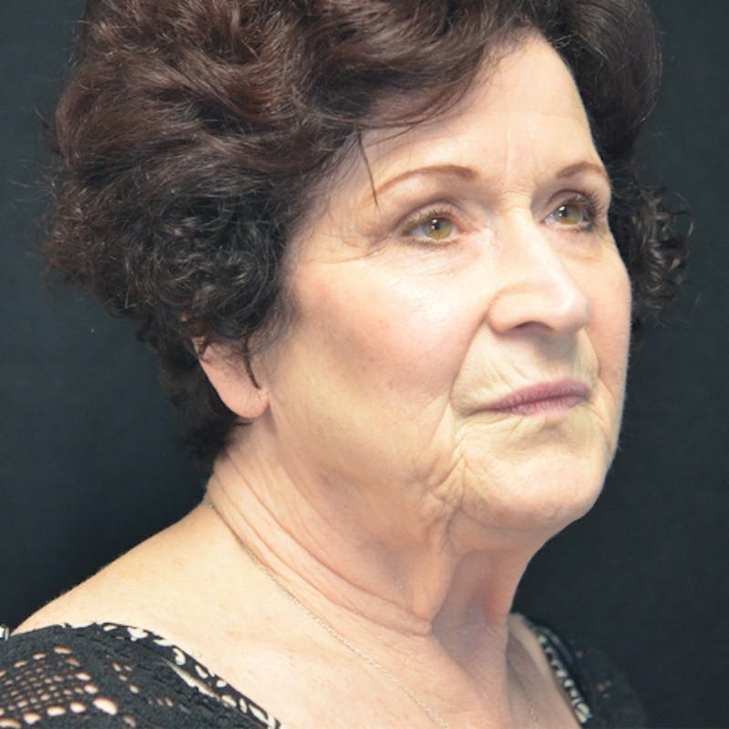Facelift Before & After Gallery - Patient 114721148 - Image 3