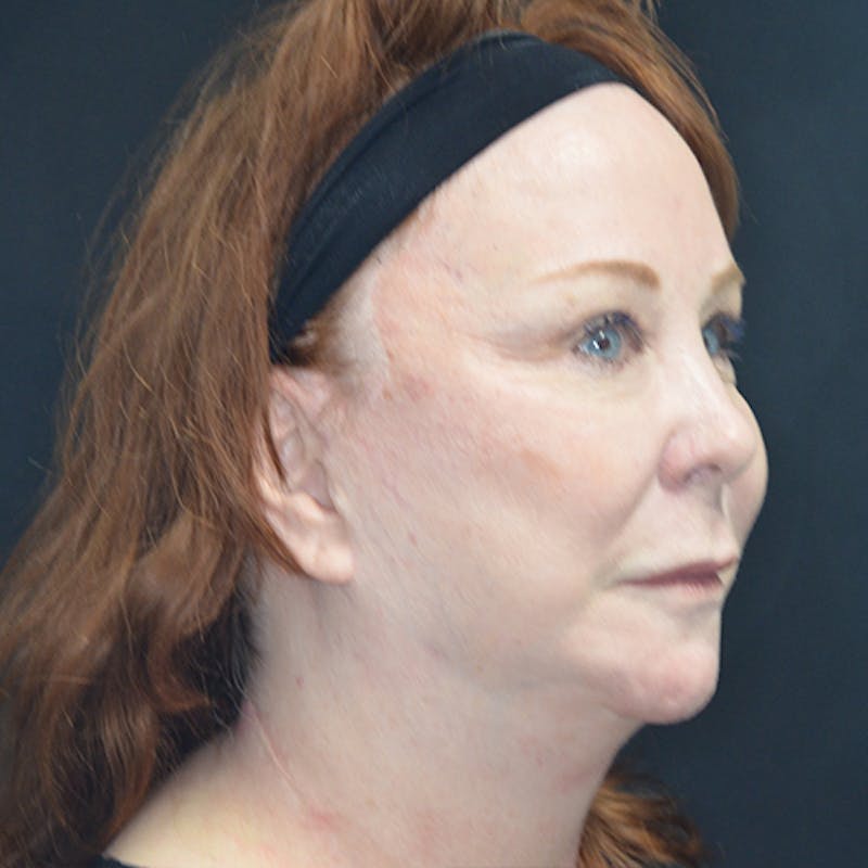 Facial Fat Grafting Before & After Gallery - Patient 114721144 - Image 3
