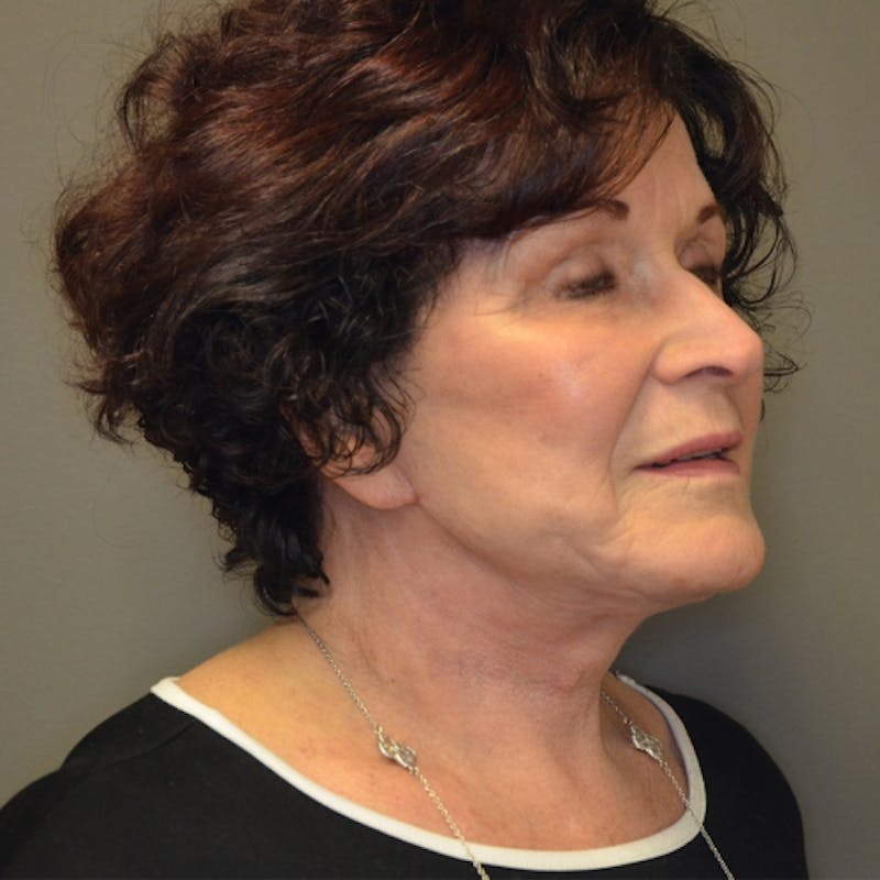 Facelift Before & After Gallery - Patient 114721148 - Image 4