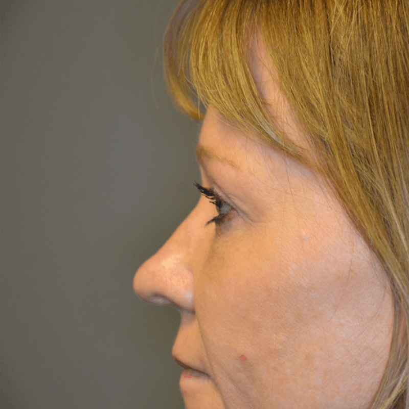 Upper Eyelid Surgery Before & After Gallery - Patient 114721140 - Image 4