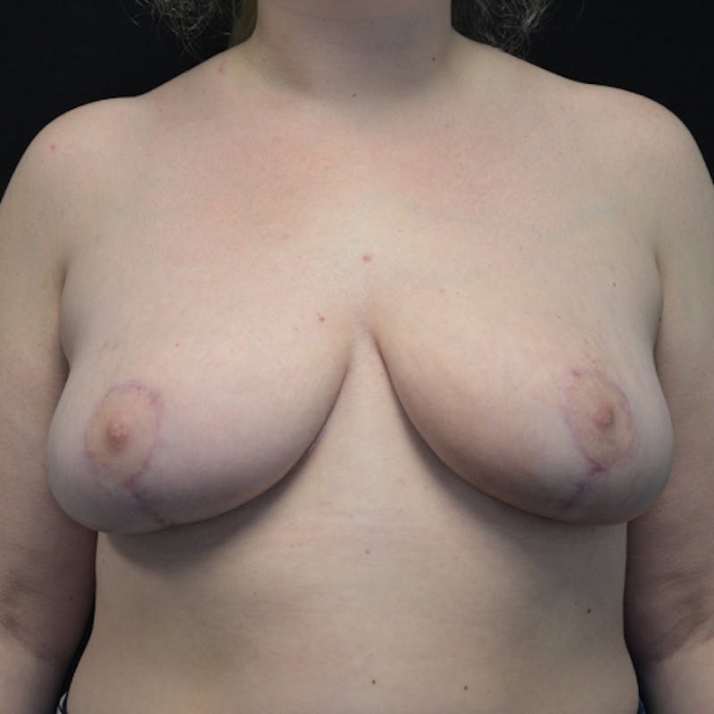Breast Reduction Before & After Gallery - Patient 114721152 - Image 2