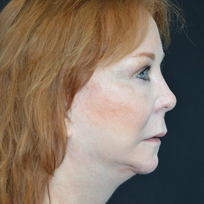 Facial Fat Grafting Before & After Gallery - Patient 114721144 - Image 6
