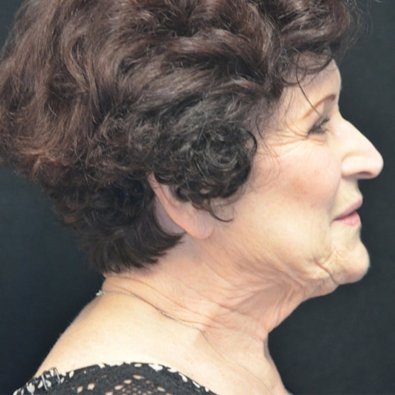Facelift Before & After Gallery - Patient 114721148 - Image 5
