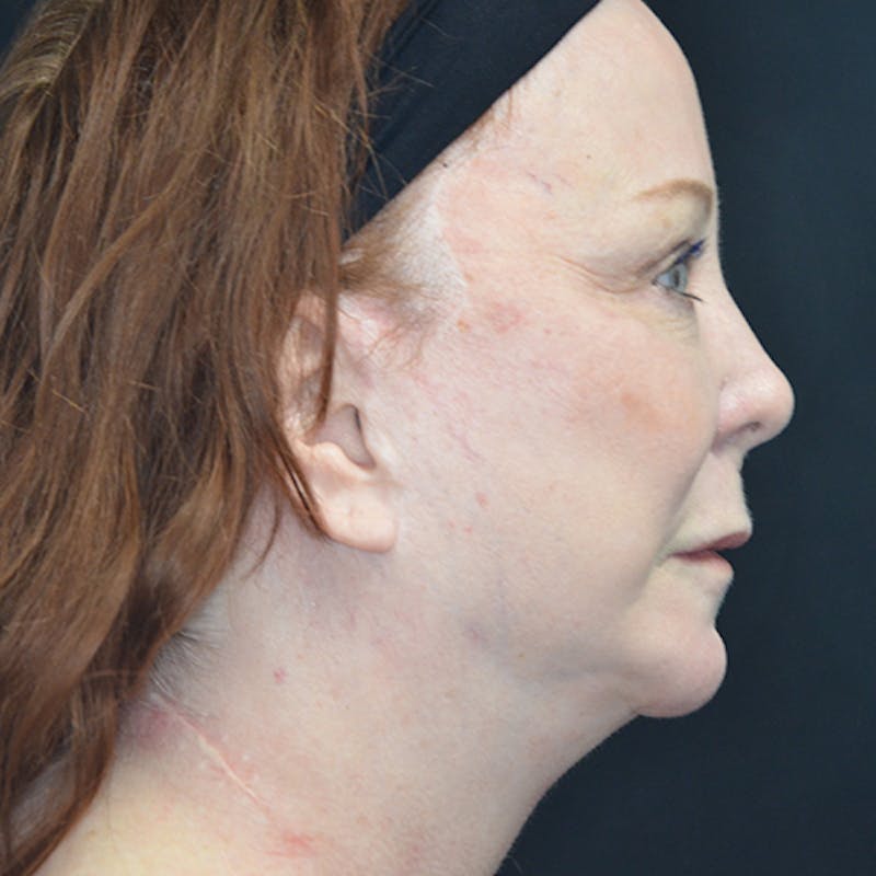 Facial Fat Grafting Before & After Gallery - Patient 114721144 - Image 5