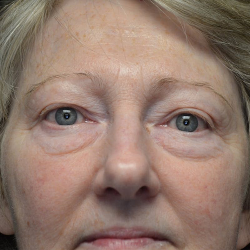 Lower Eyelid Surgery Before & After Gallery - Patient 118186862 - Image 1