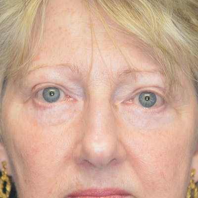 Lower Eyelid Surgery Before & After Gallery - Patient 118186862 - Image 2