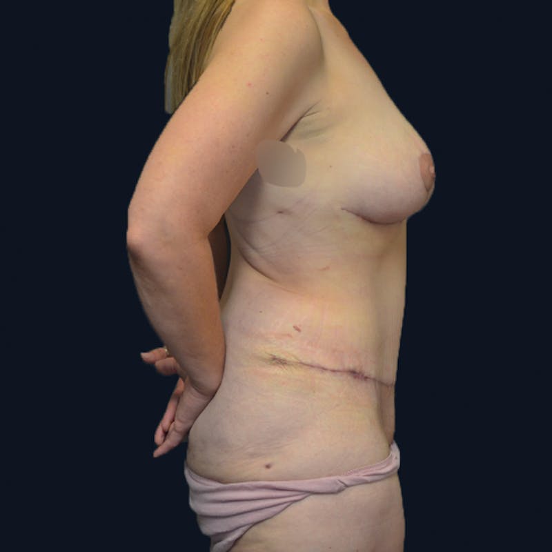 Mommy Makeover Before & After Gallery - Patient 114721147 - Image 10