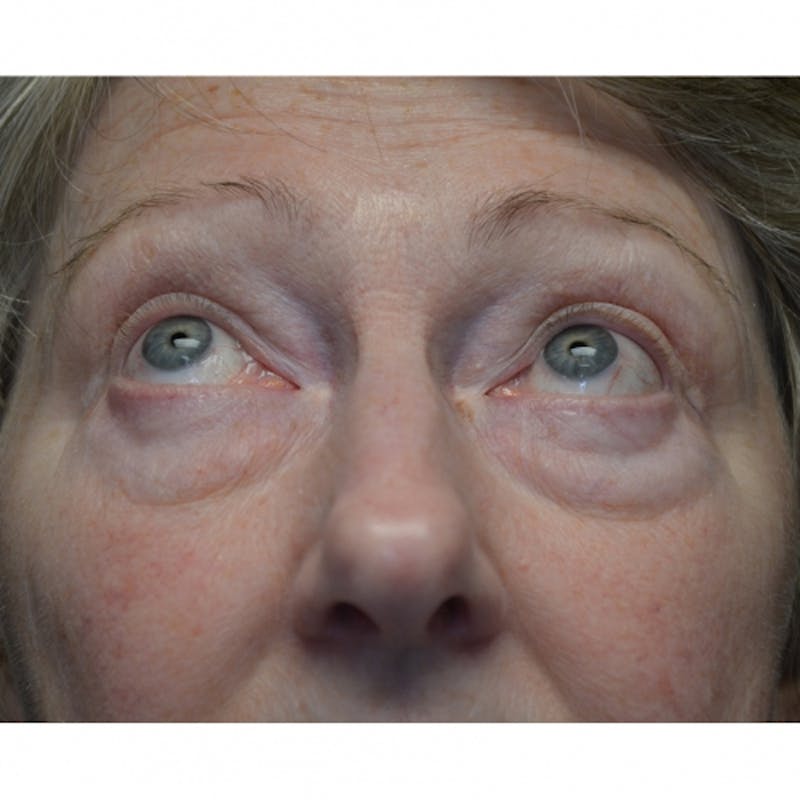 Lower Eyelid Surgery Before & After Gallery - Patient 118186862 - Image 3