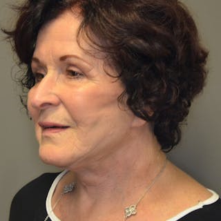 Facelift Before & After Gallery - Patient 114721148 - Image 8