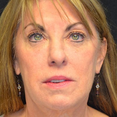 Facial Fat Grafting Before & After Gallery - Patient 114721156 - Image 2