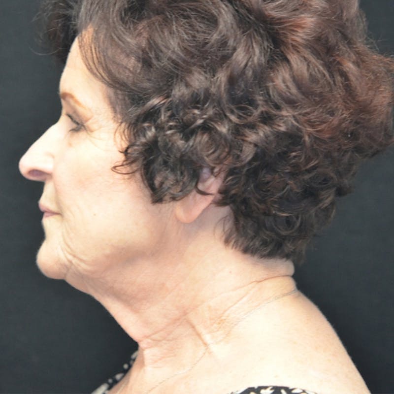 Facelift Before & After Gallery - Patient 114721148 - Image 9