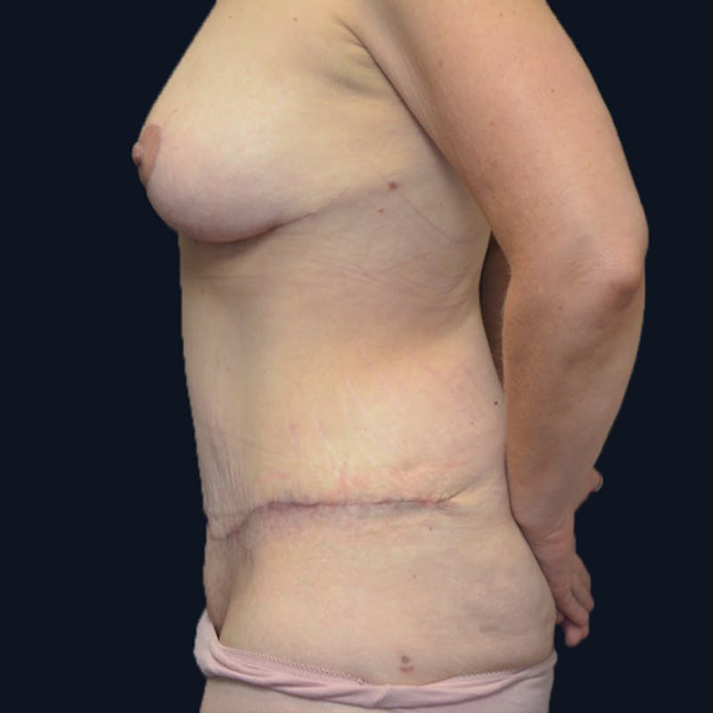 Mommy Makeover Before & After Gallery - Patient 114721147 - Image 12