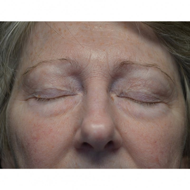 Lower Eyelid Surgery Before & After Gallery - Patient 118186862 - Image 5