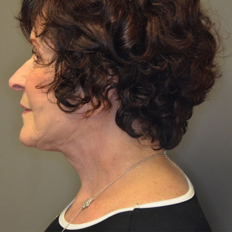 Facelift Before & After Gallery - Patient 114721148 - Image 10