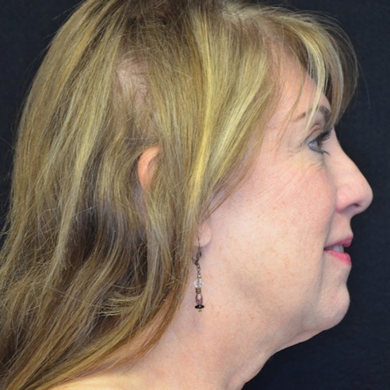 Facial Fat Grafting Before & After Gallery - Patient 114721156 - Image 4