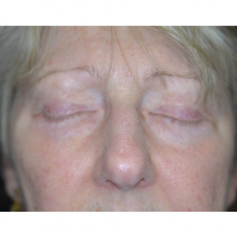 Lower Eyelid Surgery Before & After Gallery - Patient 118186862 - Image 6