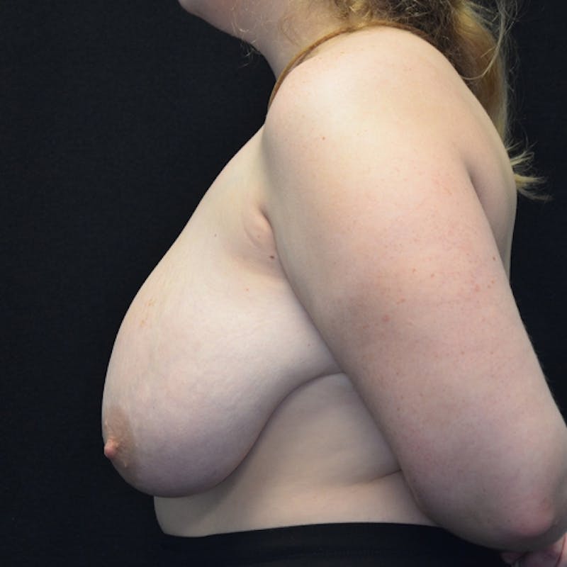 Breast Reduction Before & After Gallery - Patient 114721152 - Image 9