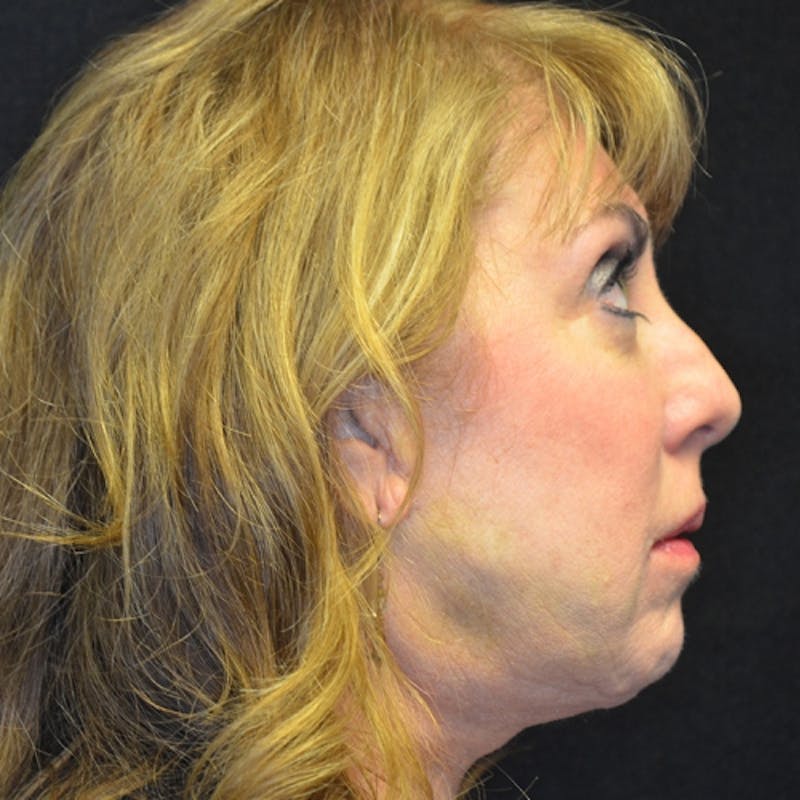Facial Fat Grafting Before & After Gallery - Patient 114721156 - Image 3