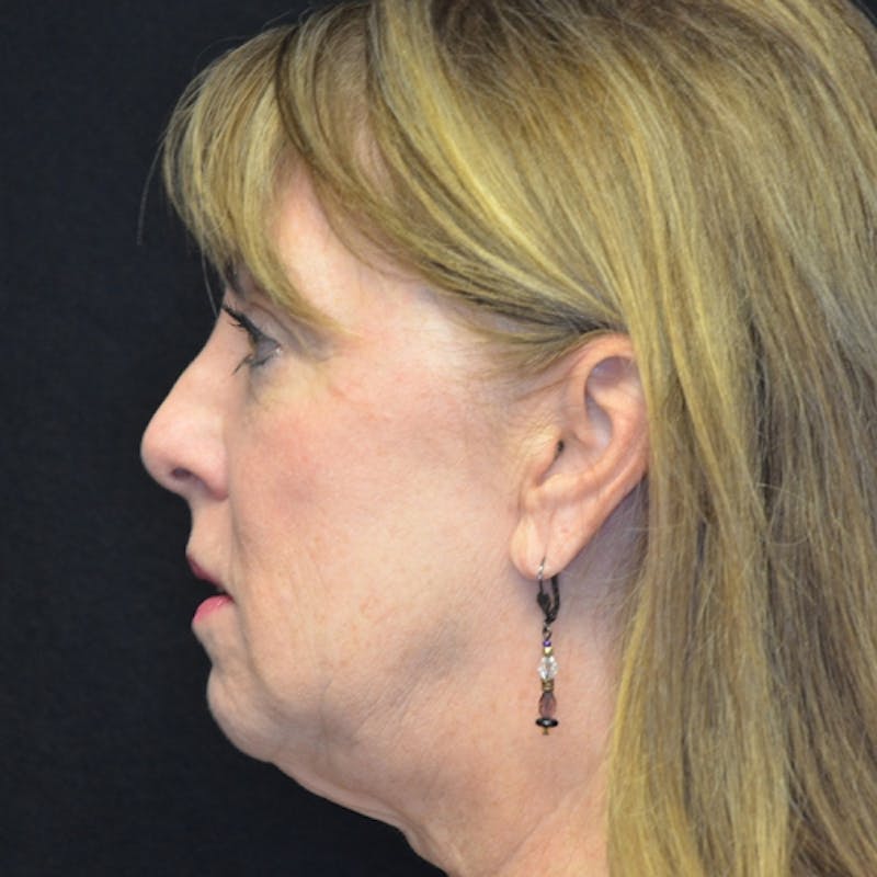 Facial Fat Grafting Before & After Gallery - Patient 114721156 - Image 6