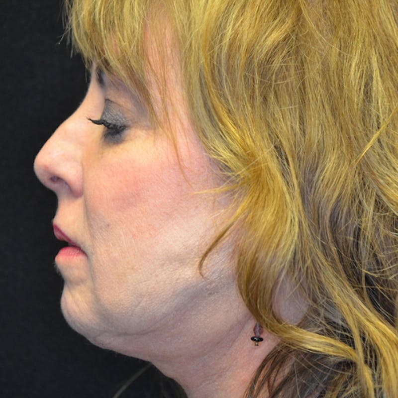 Facial Fat Grafting Before & After Gallery - Patient 114721156 - Image 5