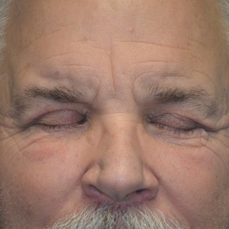Upper Eyelid Surgery Before & After Gallery - Patient 114721161 - Image 4