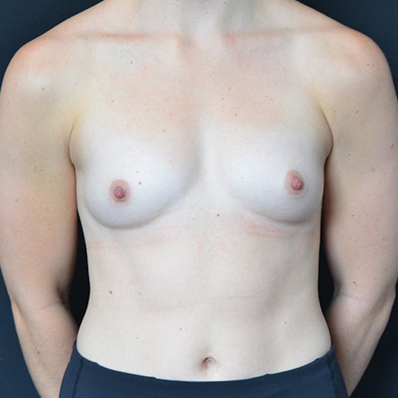 Breast Augmentation Before & After Gallery - Patient 114721163 - Image 1