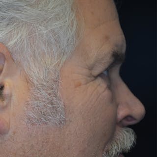 Upper Eyelid Surgery Before & After Gallery - Patient 114721161 - Image 8