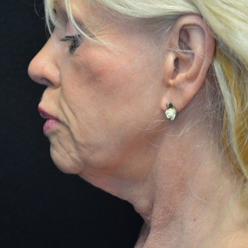 Facial Fat Grafting Before & After Gallery - Patient 114721160 - Image 5