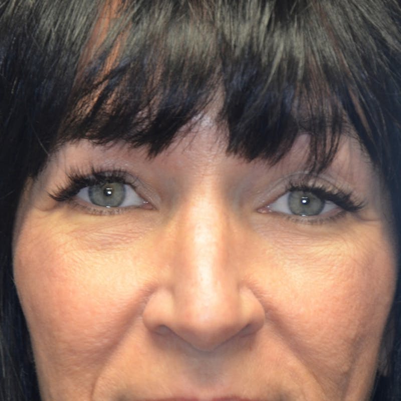 Upper Eyelid Surgery Before & After Gallery - Patient 114721165 - Image 1