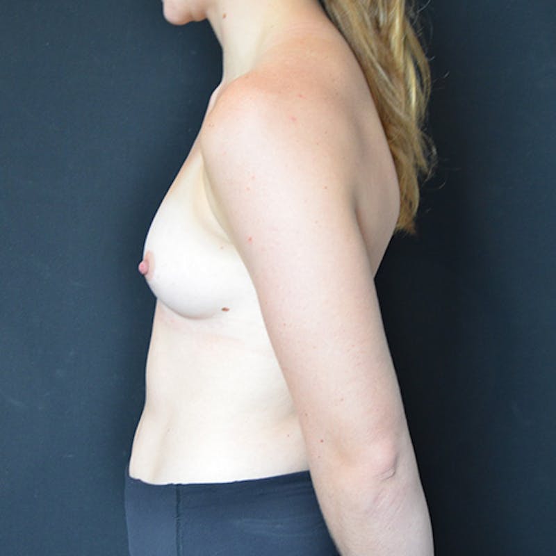 Breast Augmentation Before & After Gallery - Patient 114721163 - Image 7